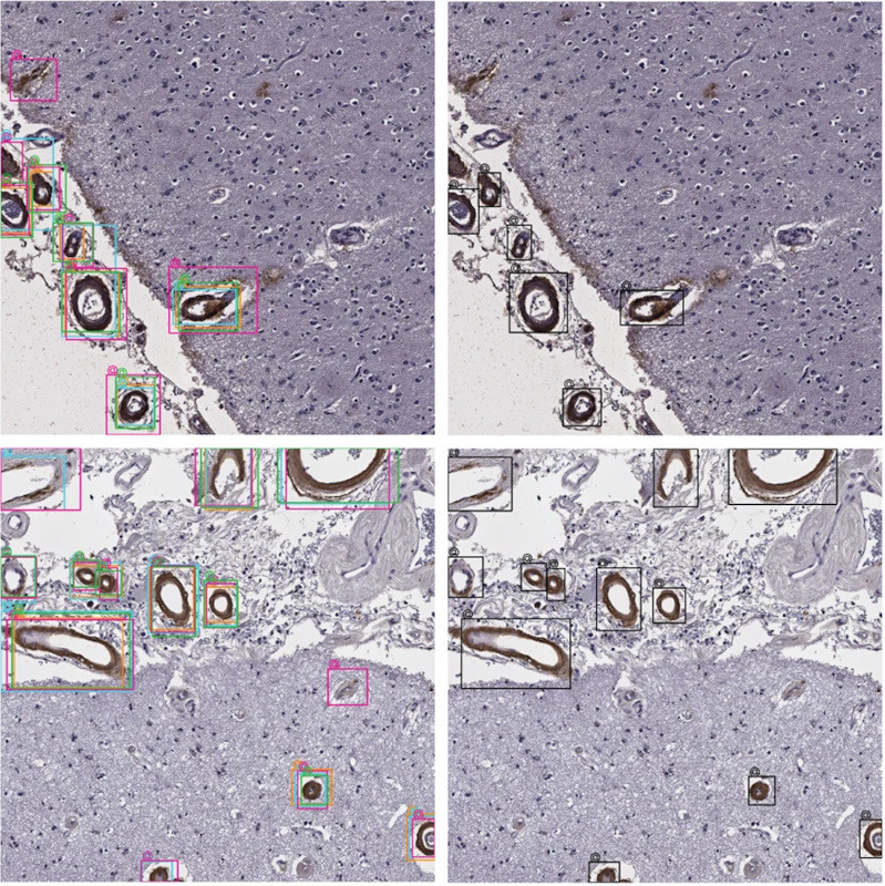 Learning fast and fine-grained detection of amyloid neuropathologies from coarse-grained expert labels